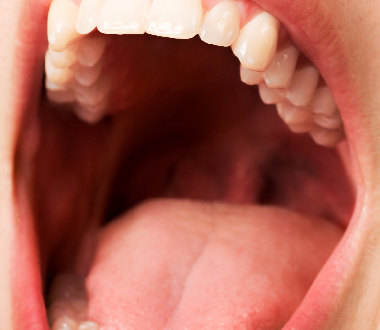 Understanding and Managing Dry Mouth: Causes, Symptoms, and Remedies