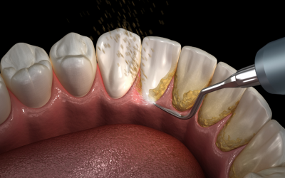 What’s the Difference Between Plaque and Tartar?