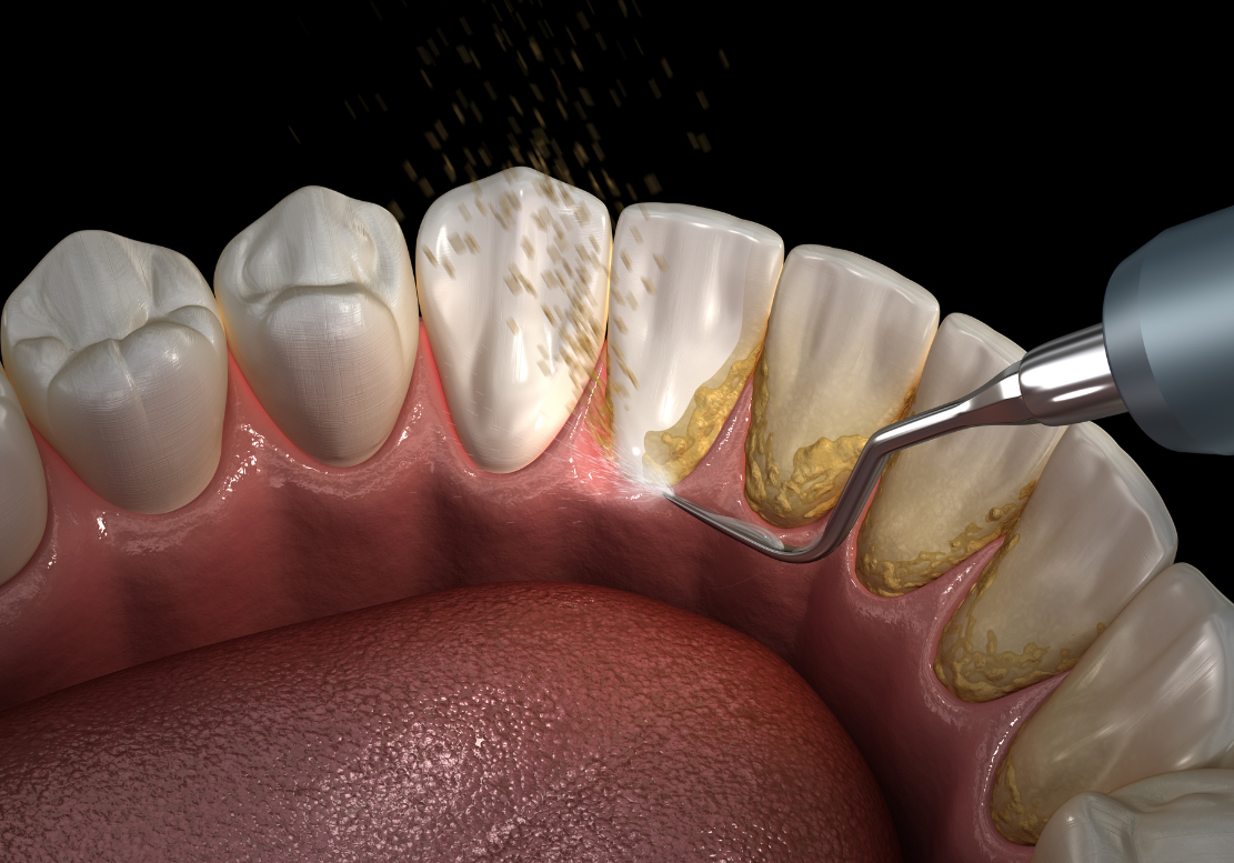 Causes of soft teeth