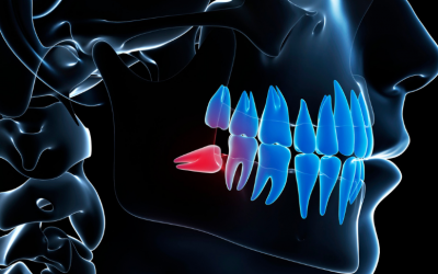 Wisdom Teeth: Removal, Recovery, and Myths