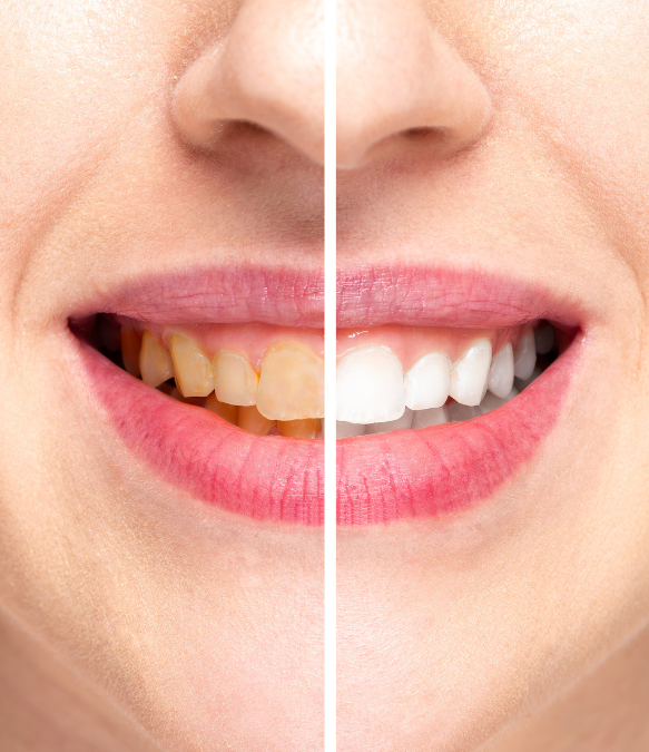 How to Prevent Tooth Discoloration and Keep Your Smile Bright