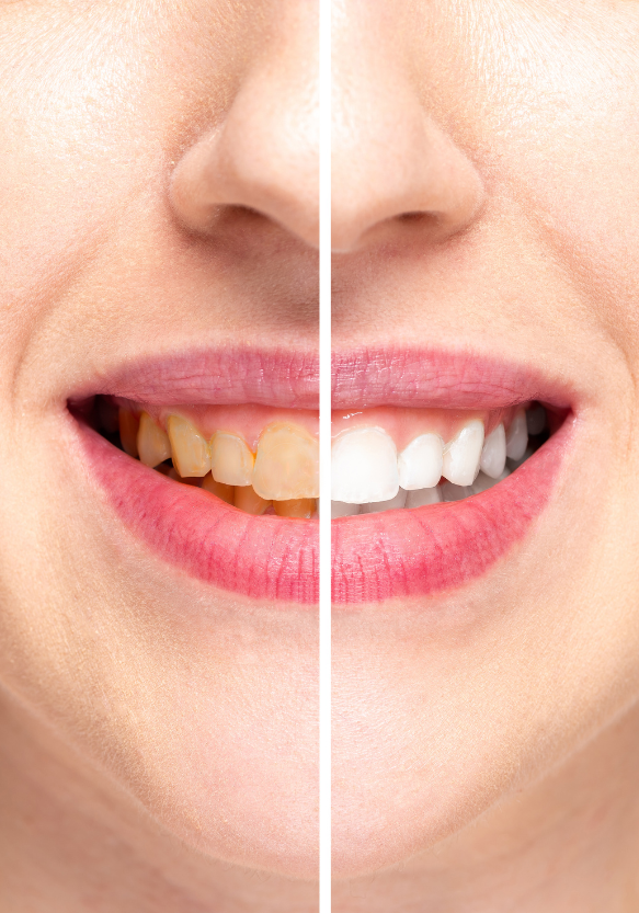 prevent tooth discoloration